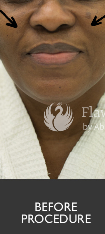 Smile Lines And Nasolabial Fold Fillers Before and After | Flawless Aesthetic Center