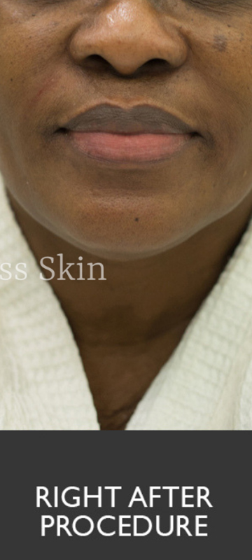 Smile Lines And Nasolabial Fold Fillers Before and After | Flawless Aesthetic Center