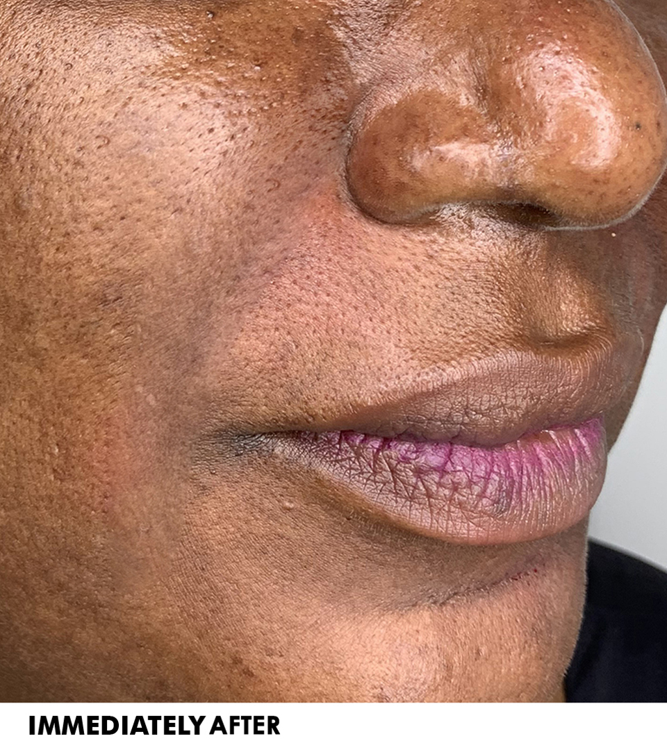 Smile Lines And Nasolabial Fold Fillers Before and After | Flawless Aesthetic Center