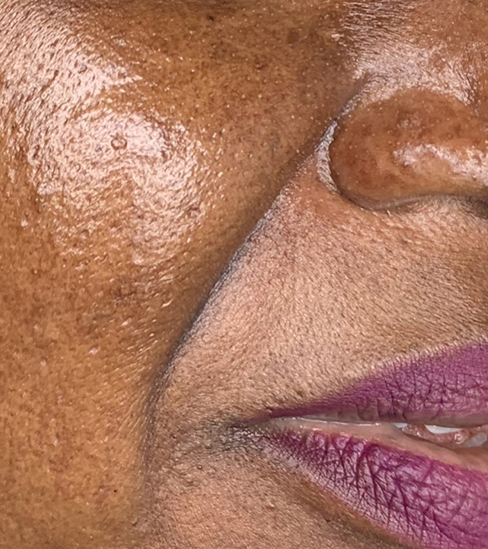 Smile Lines And Nasolabial Fold Fillers Before and After | Flawless Aesthetic Center