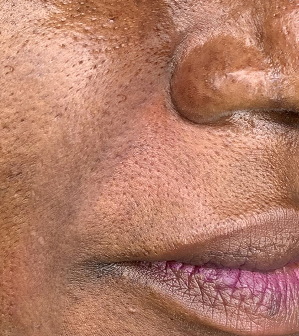 Smile Lines And Nasolabial Fold Fillers Before and After | Flawless Aesthetic Center