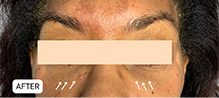 Tear Trough And Under Eye Fillers Before and After | Flawless Aesthetic Center