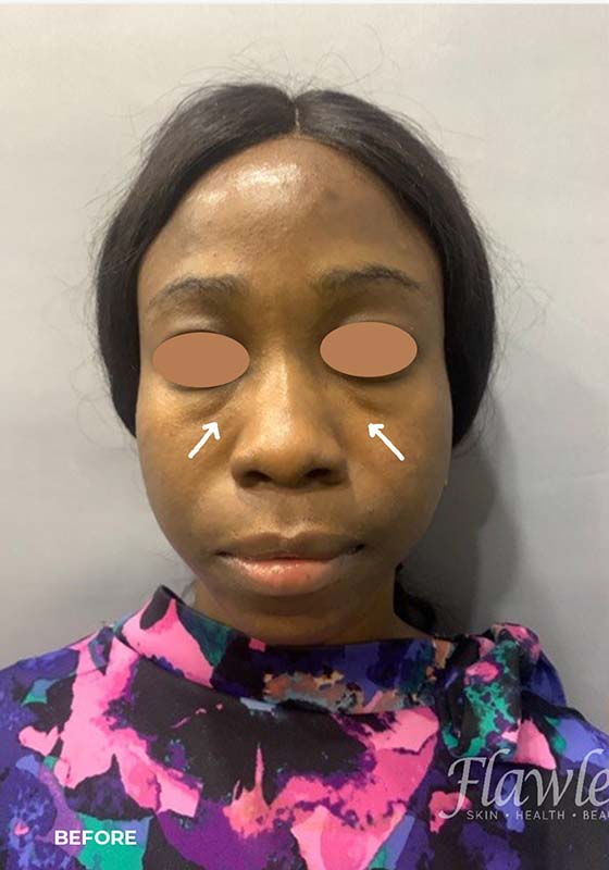 Tear Trough And Under Eye Fillers Before and After | Flawless Aesthetic Center