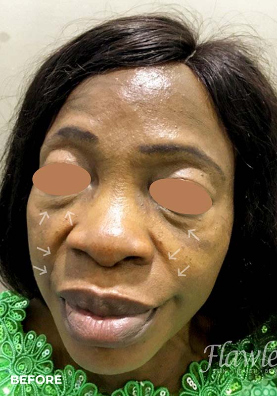 Tear Trough And Under Eye Fillers Before and After | Flawless Aesthetic Center
