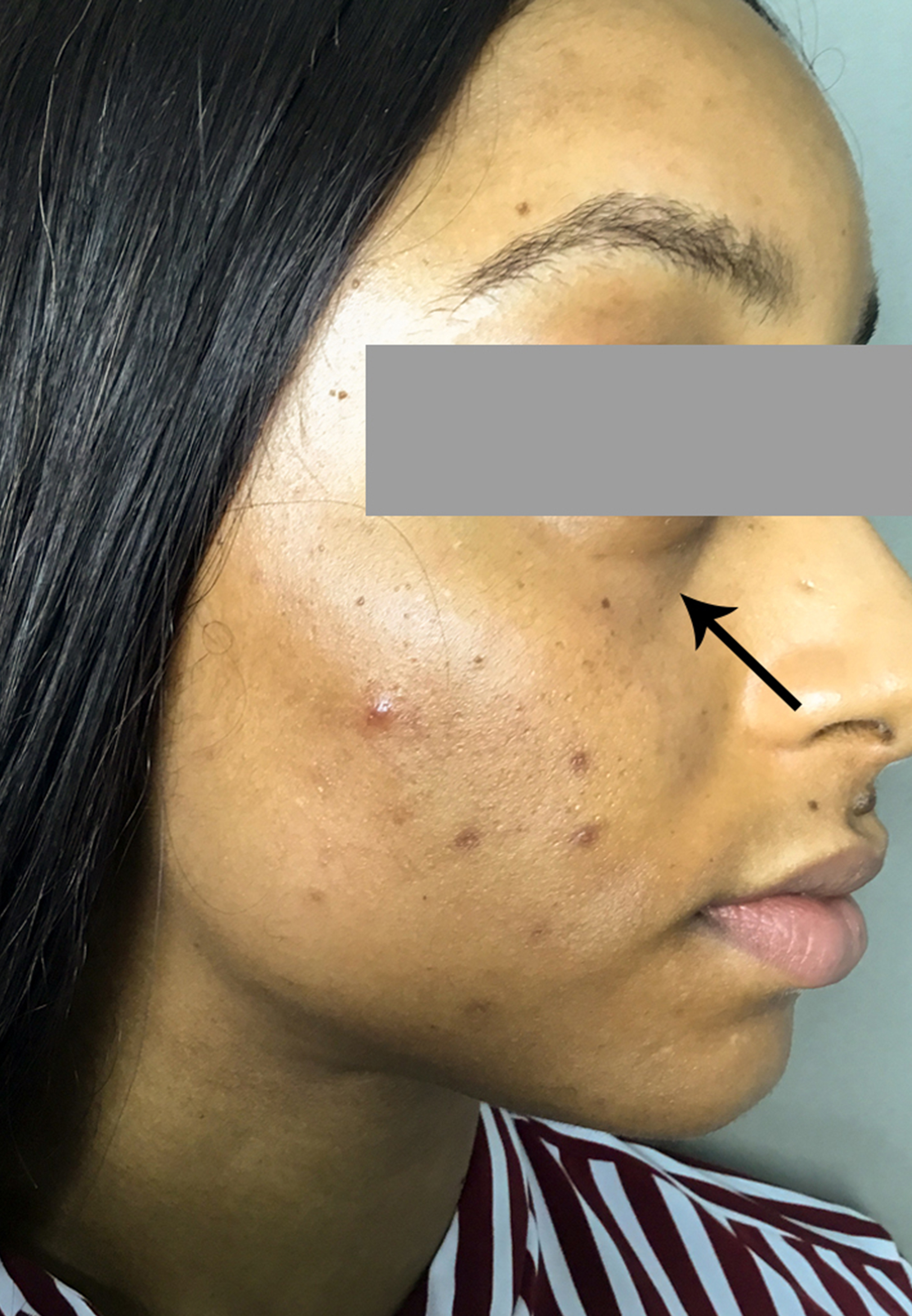 Tear Trough And Under Eye Fillers Before and After | Flawless Aesthetic Center