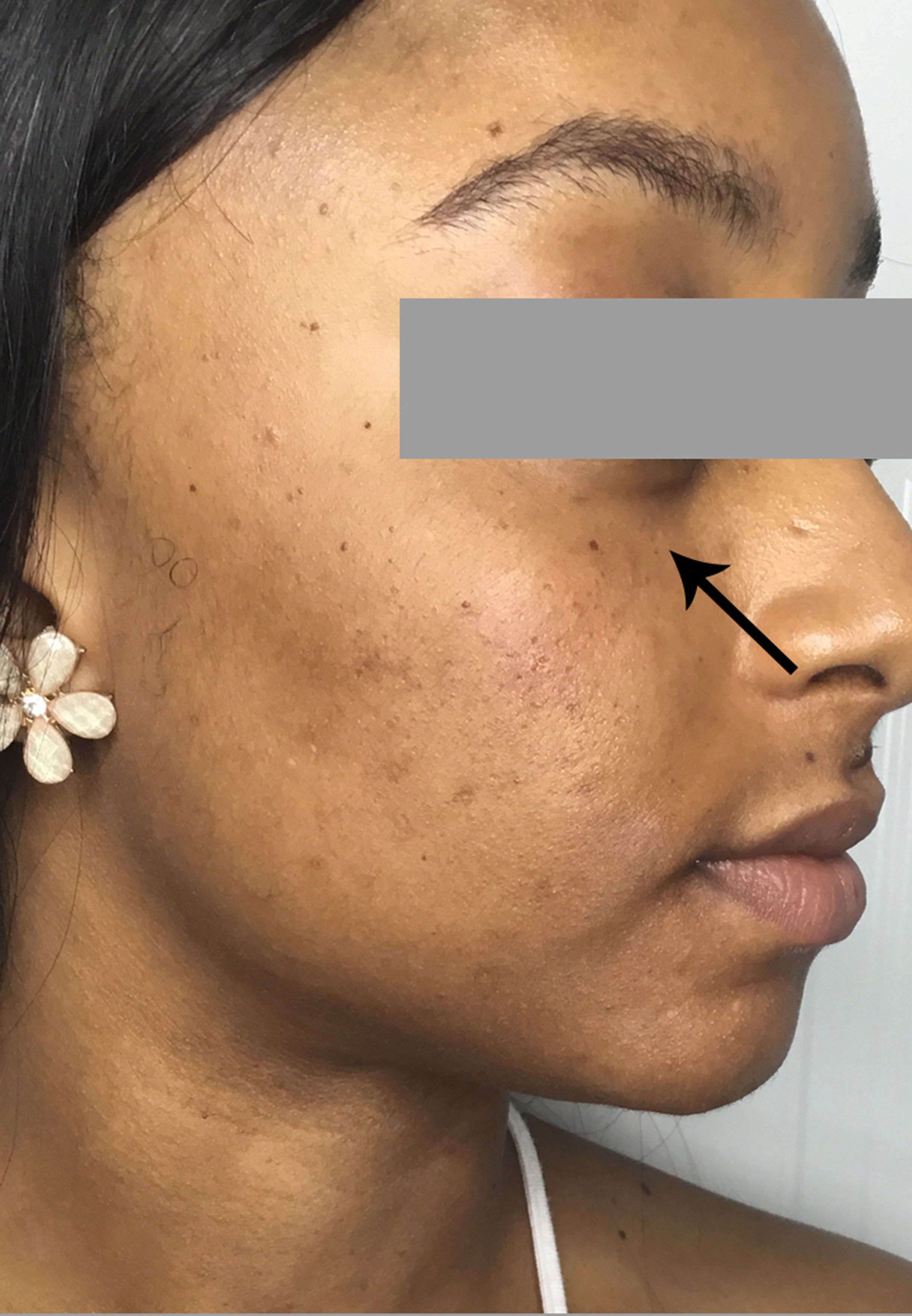 Tear Trough And Under Eye Fillers Before and After | Flawless Aesthetic Center