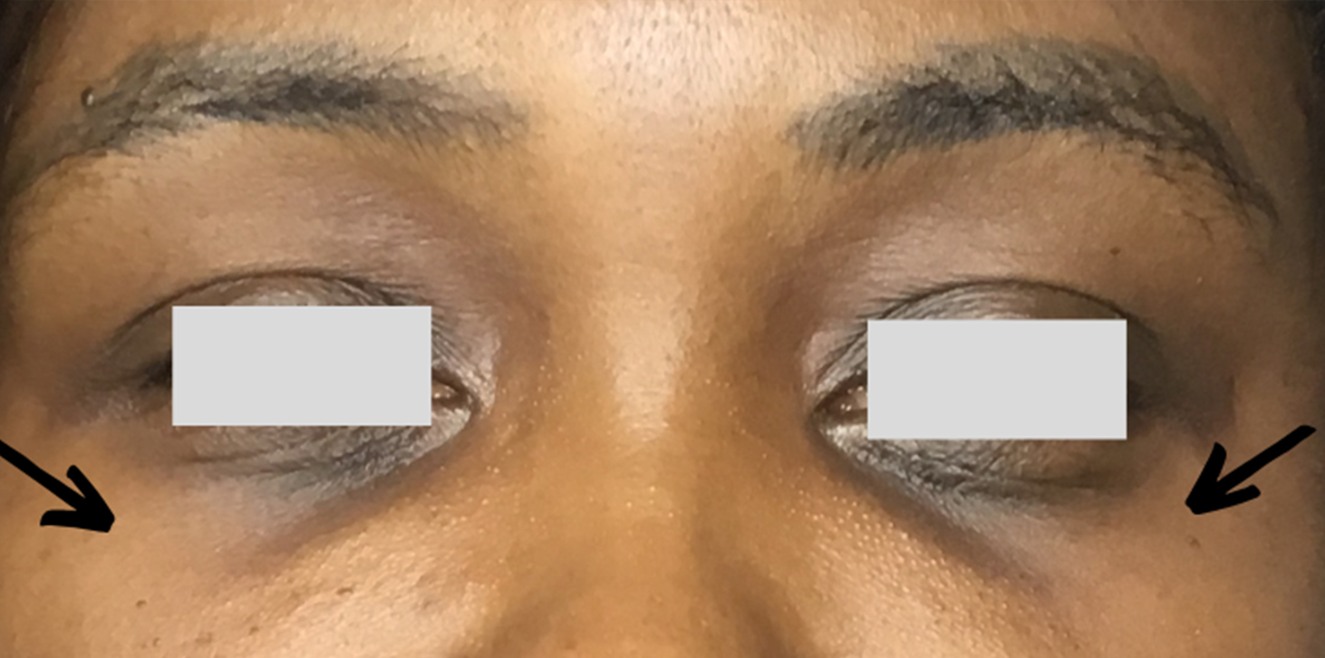 Tear Trough And Under Eye Fillers Before and After | Flawless Aesthetic Center