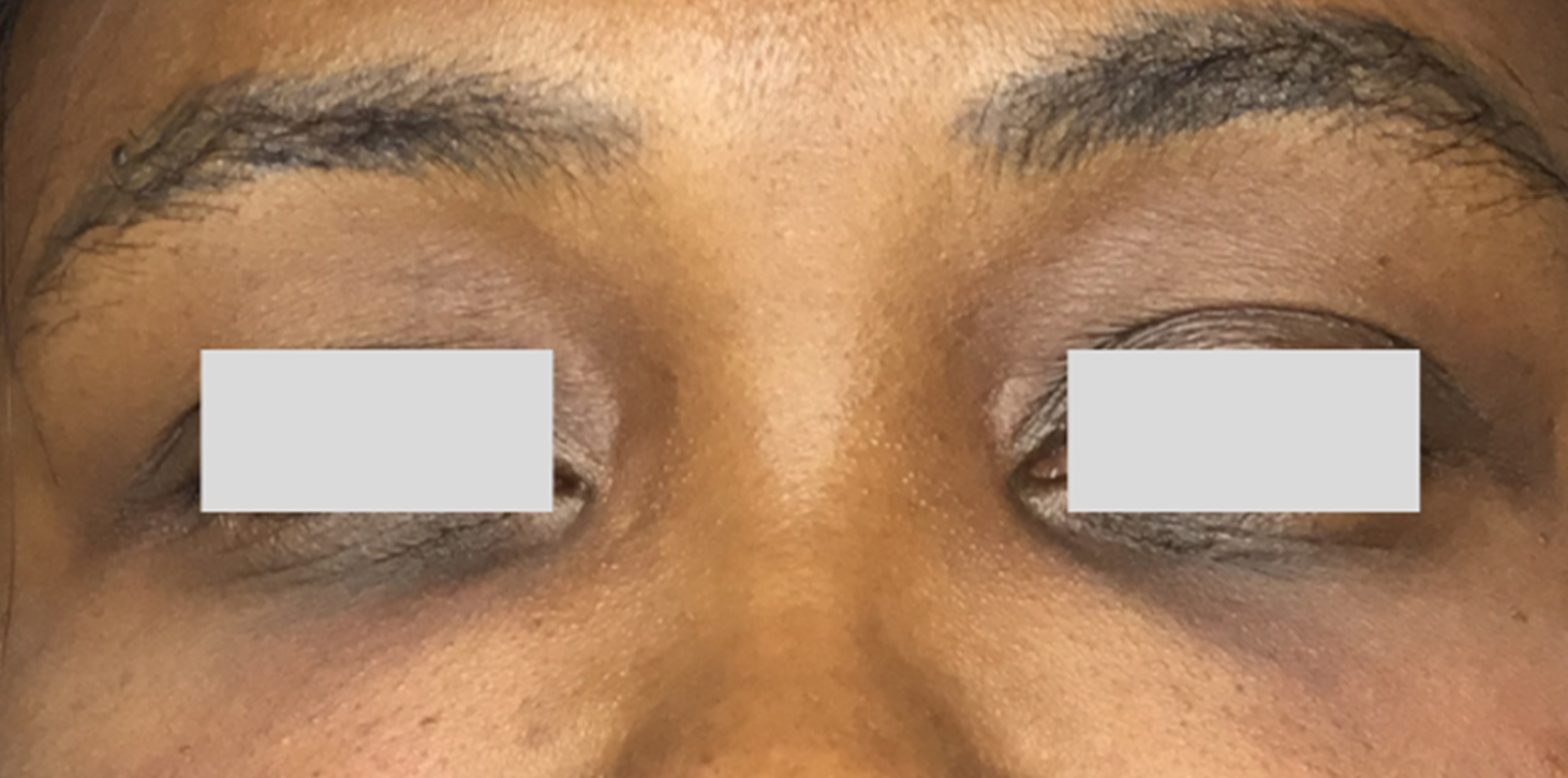 Tear Trough And Under Eye Fillers Before and After | Flawless Aesthetic Center