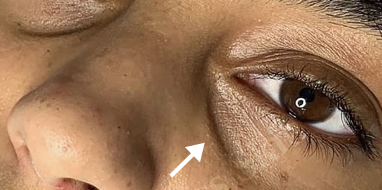 Tear Trough And Under Eye Fillers Before and After | Flawless Aesthetic Center