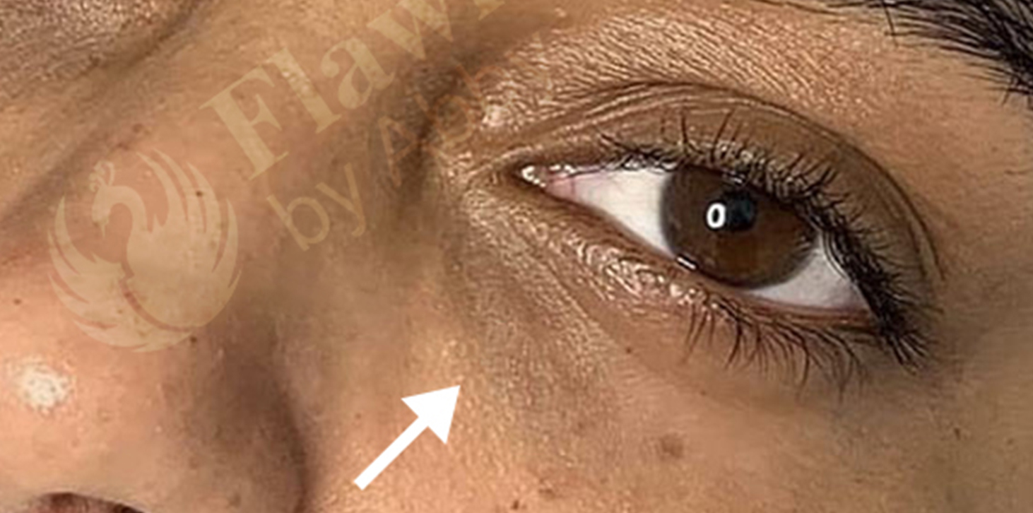 Tear Trough And Under Eye Fillers Before and After | Flawless Aesthetic Center