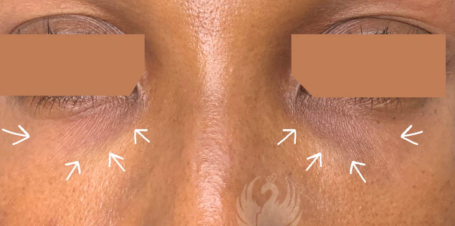 Tear Trough And Under Eye Fillers Before and After | Flawless Aesthetic Center