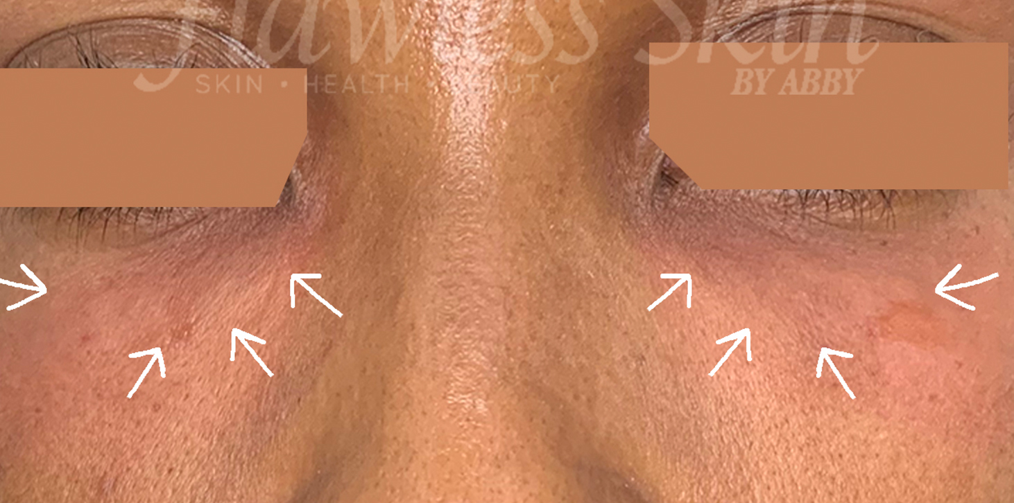 Tear Trough And Under Eye Fillers Before and After | Flawless Skin