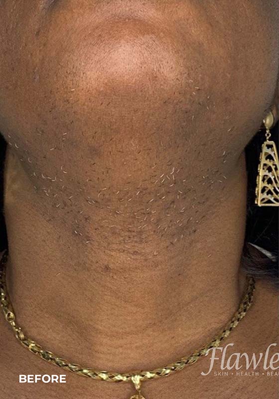 Laser Hair Removal Before and After | Flawless Aesthetic Center