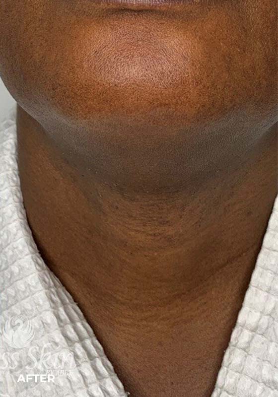 Laser Hair Removal Before and After | Flawless Aesthetic Center