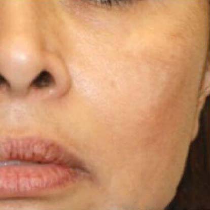 Laser Skin Treatments Before and After | Flawless Aesthetic Center