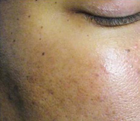 Laser Skin Treatments Before and After | Flawless Aesthetic Center
