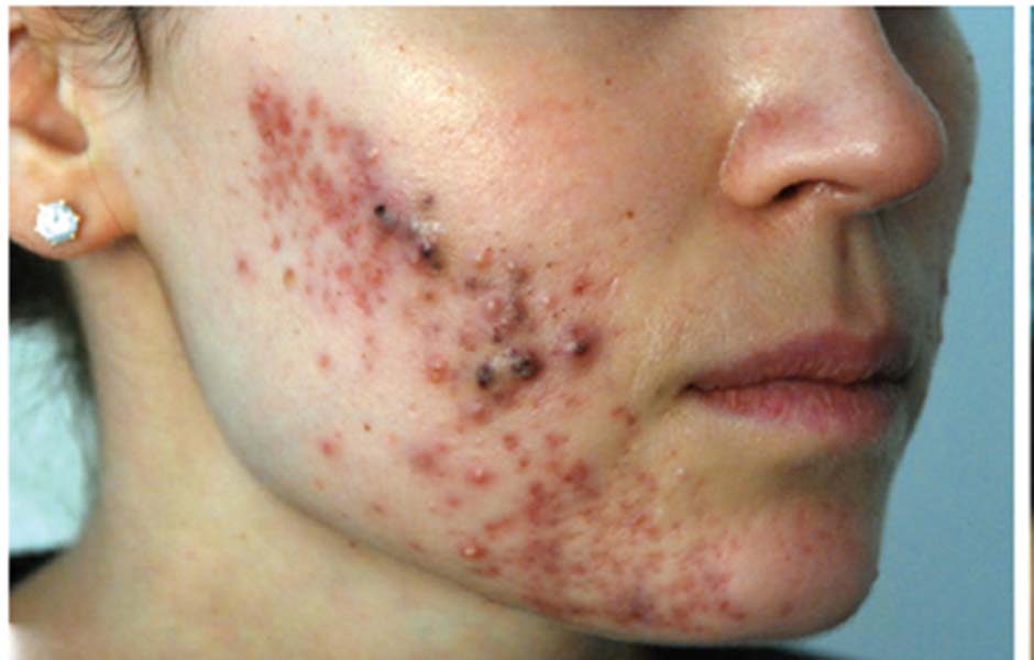 Laser Skin Treatments Before and After | Flawless Aesthetic Center