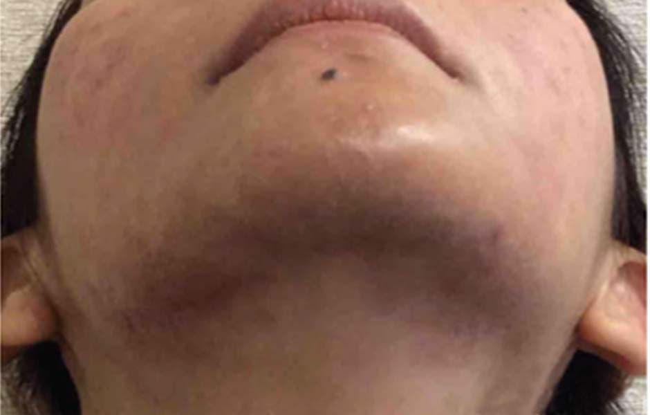 Laser Skin Treatments Before and After | Flawless Aesthetic Center