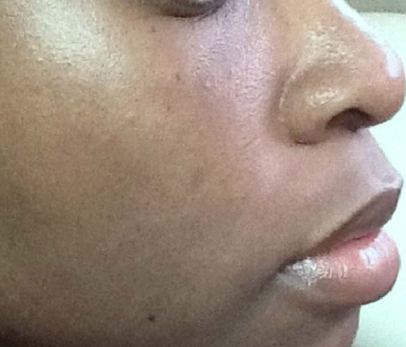 Laser Skin Treatments Before and After | Flawless Aesthetic Center