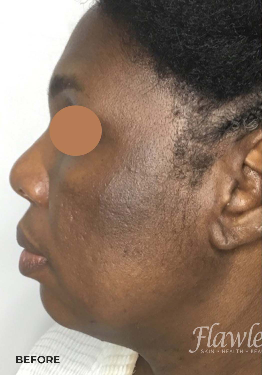 Acne Facial Procedure Before and After | Flawless Aesthetic Center