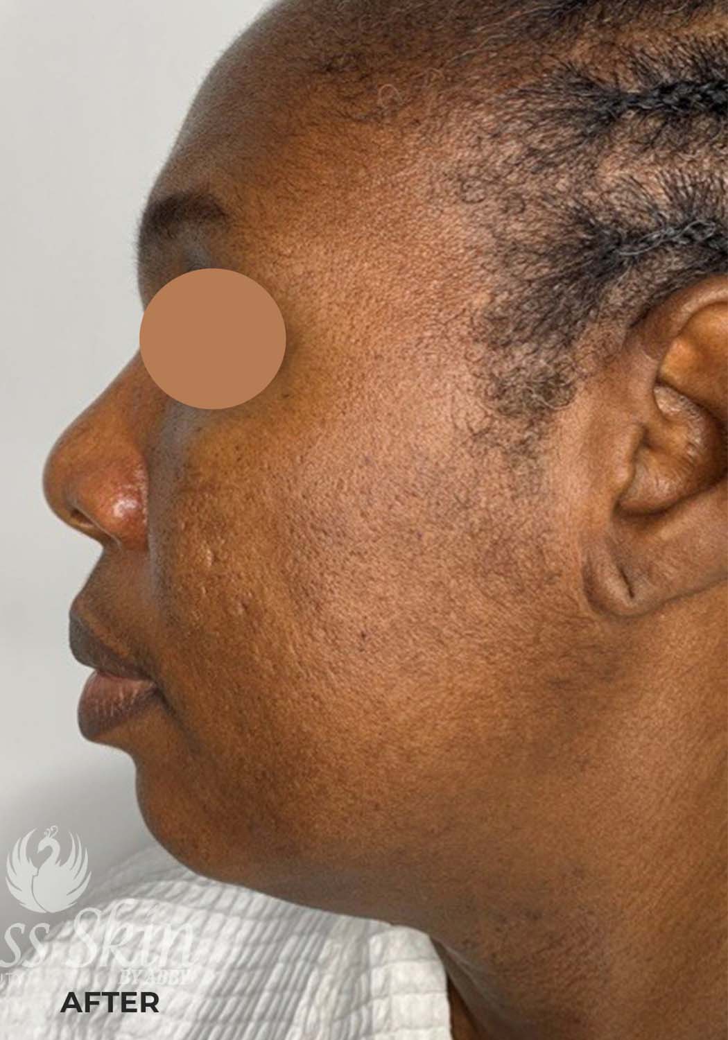 Acne Facial Procedure Before and After | Flawless Aesthetic Center