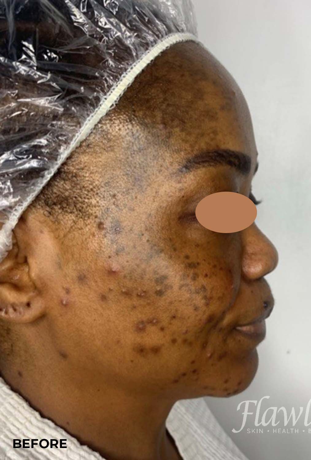Acne Facial Procedure Before and After | Flawless Aesthetic Center
