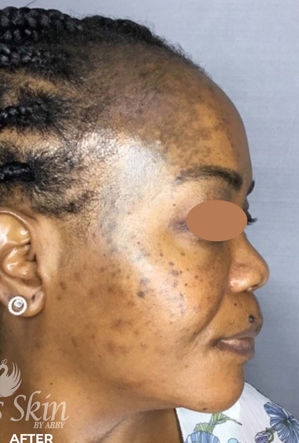 Acne Facial Procedure Before and After | Flawless Aesthetic Center