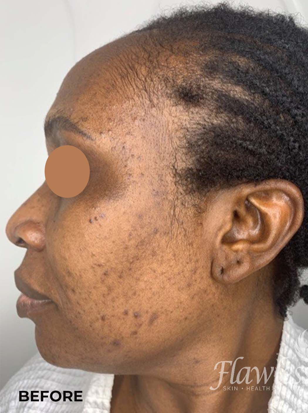 Acne Facial Procedure Before and After | Flawless Aesthetic Center
