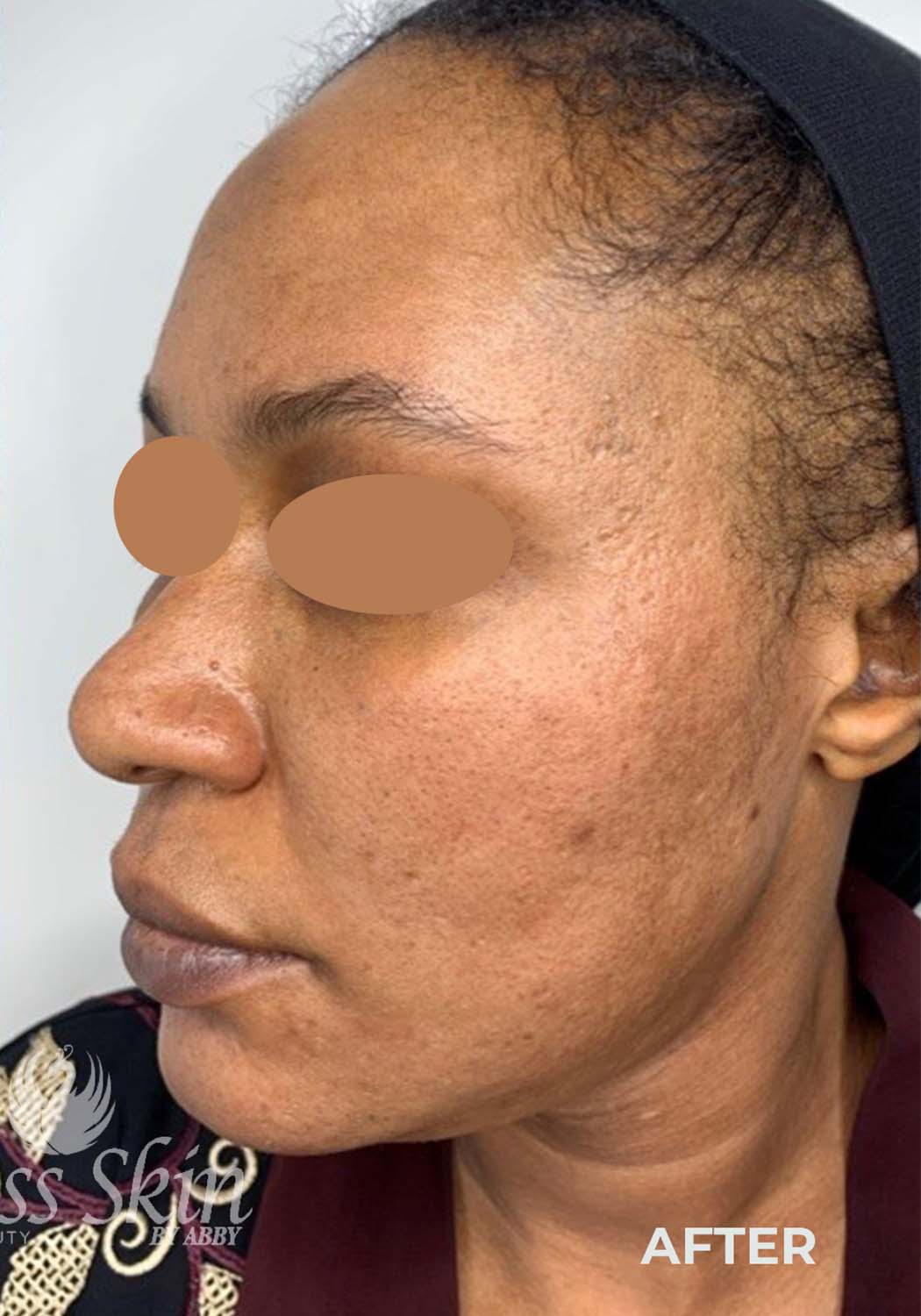 Acne Facial Procedure Before and After | Flawless Aesthetic Center