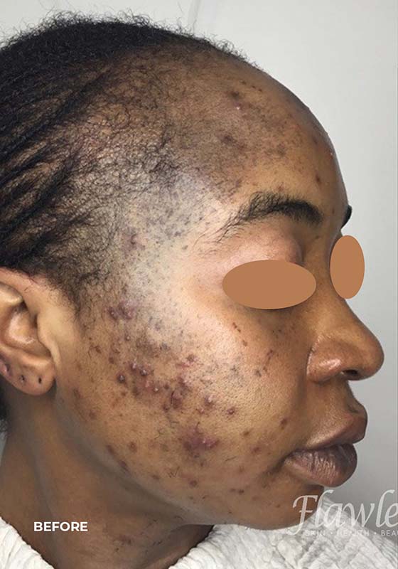 Acne Facial Procedure Before and After | Flawless Aesthetic Center