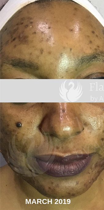 Acne Facial Procedure Before and After | Flawless Aesthetic Center