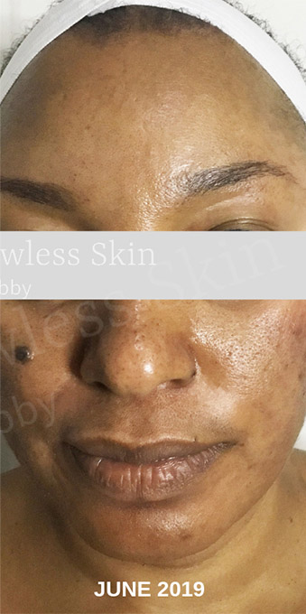 Acne Facial Procedure Before and After | Flawless Aesthetic Center
