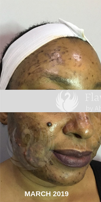 Acne Facial Procedure Before and After | Flawless Aesthetic Center