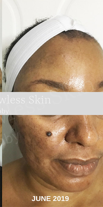Acne Facial Procedure Before and After | Flawless Aesthetic Center