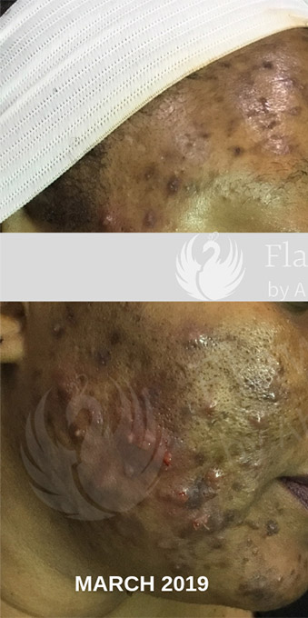 Acne Facial Procedure Before and After | Flawless Aesthetic Center