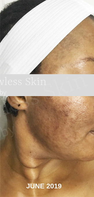 Acne Facial Procedure Before and After | Flawless Aesthetic Center