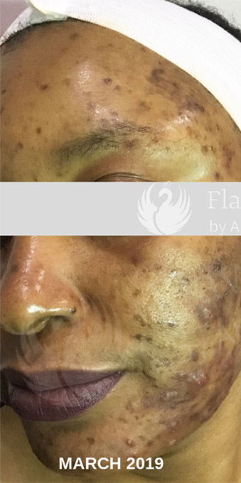 Acne Facial Procedure Before and After | Flawless Aesthetic Center
