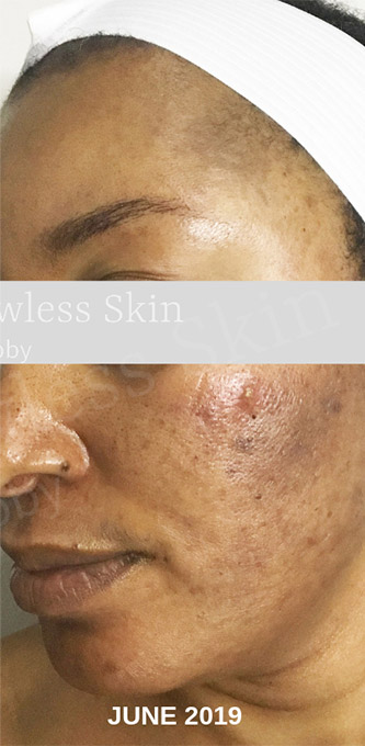 Acne Facial Procedure Before and After | Flawless Aesthetic Center