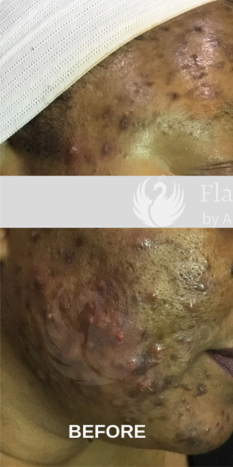Acne Facial Procedure Before and After | Flawless Aesthetic Center