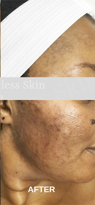 Acne Facial Procedure Before and After | Flawless Aesthetic Center