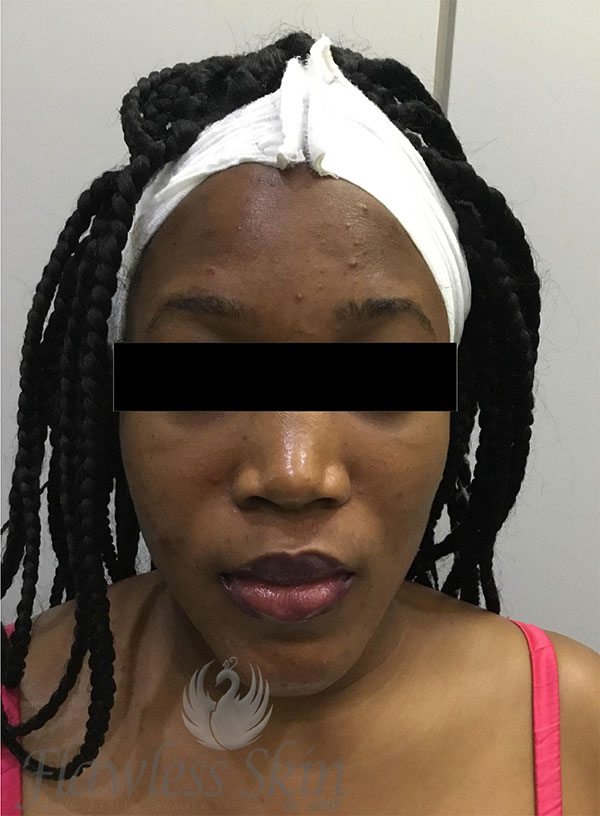 Acne Facial Procedure Before and After | Flawless Aesthetic Center