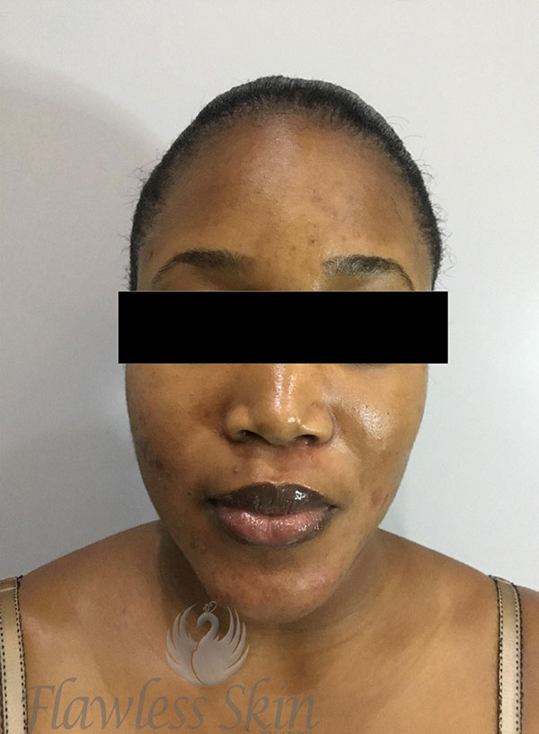 Acne Facial Procedure Before and After | Flawless Aesthetic Center