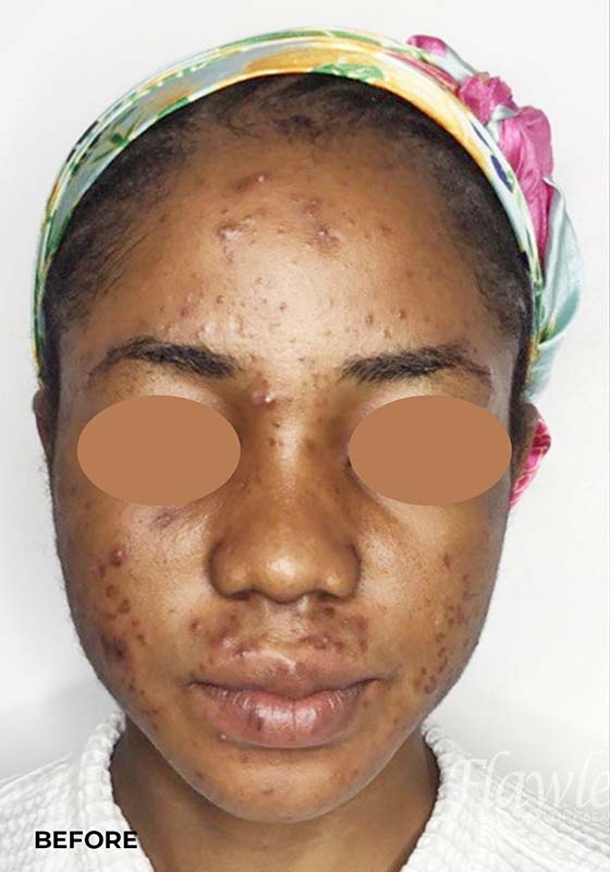 Acne Facial Procedure Before and After | Flawless Aesthetic Center
