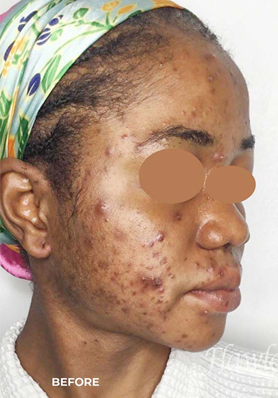 Acne Facial Procedure Before and After | Flawless Aesthetic Center