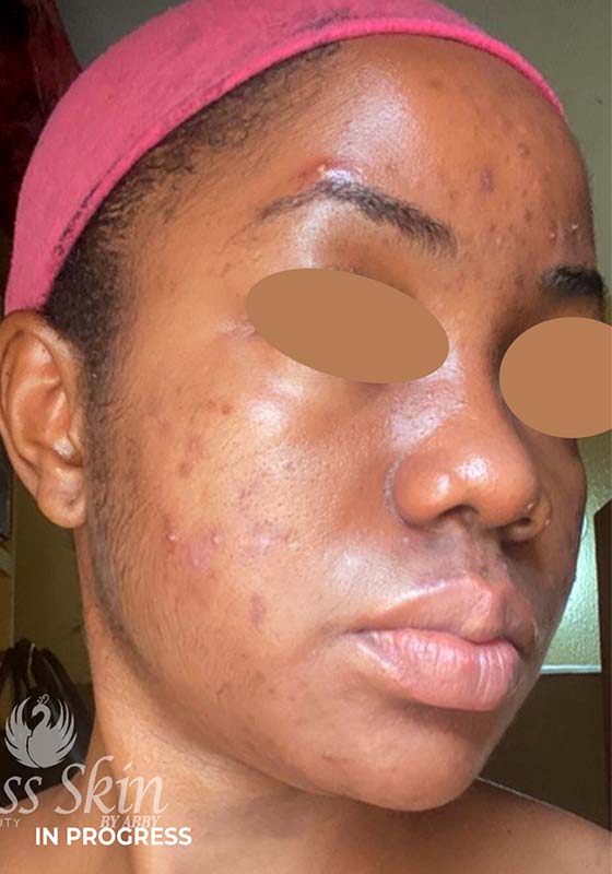 Acne Facial Procedure Before and After | Flawless Aesthetic Center