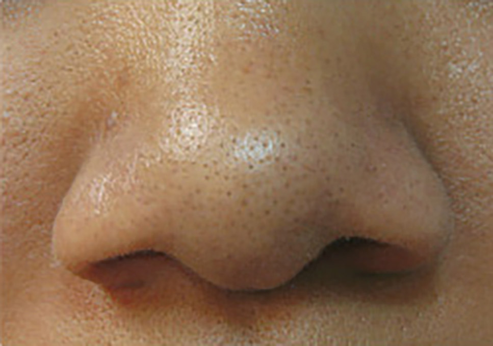 Acne Facial Procedure Before and After | Flawless Aesthetic Center