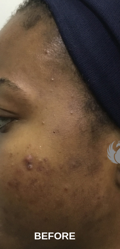 Acne Facial Procedure Before and After | Flawless Aesthetic Center