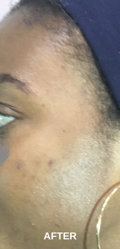 Acne Facial Procedure Before and After | Flawless Aesthetic Center