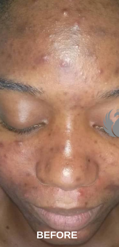 Acne Facial Procedure Before and After | Flawless Aesthetic Center