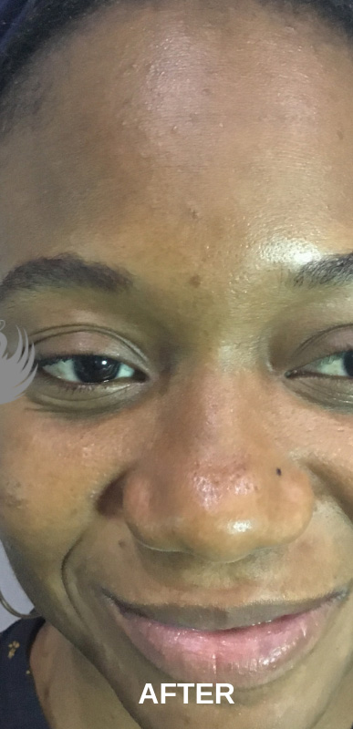 Acne Facial Procedure Before and After | Flawless Aesthetic Center